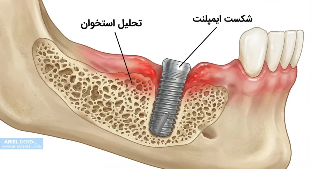 مشکلات استخوان فک در ایمپلنت