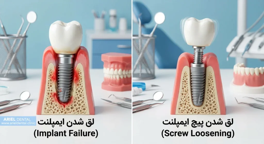 تفاوت لق شدن ایمپلنت و پیچ ایمپلنت