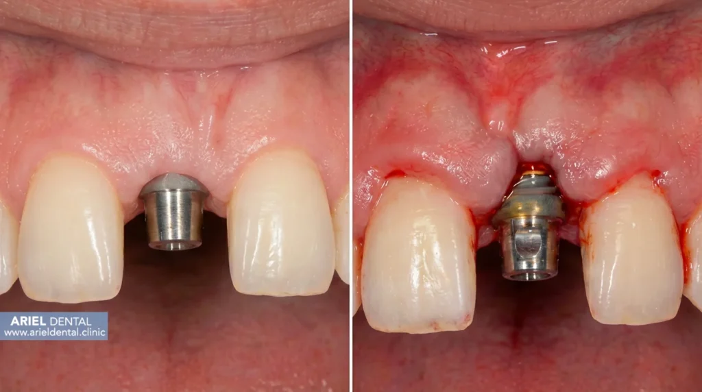 تغییرات دهان و لثه در بارداری و تاثیر آنها بر ایمپلنت دندان