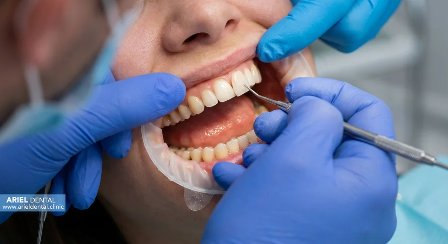 شرایط لمینت دندان اقساطی در تهران