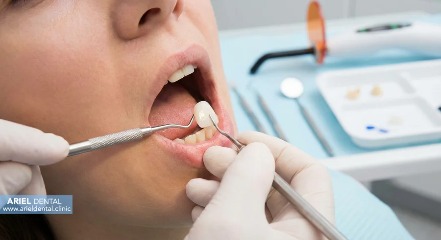 آماده سازی لمینت دندان