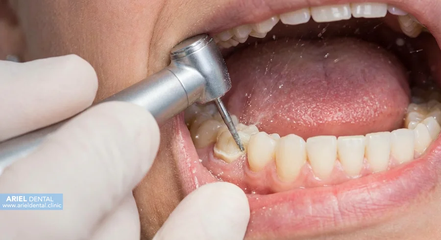 مزایا ایمپلنت دندان