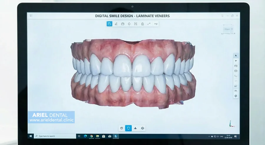 لمینت سرامیکی دیجیتال