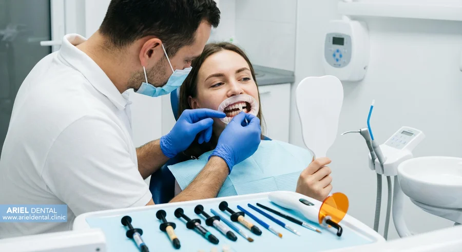 لمینت بهتر است یا کامپوزیت